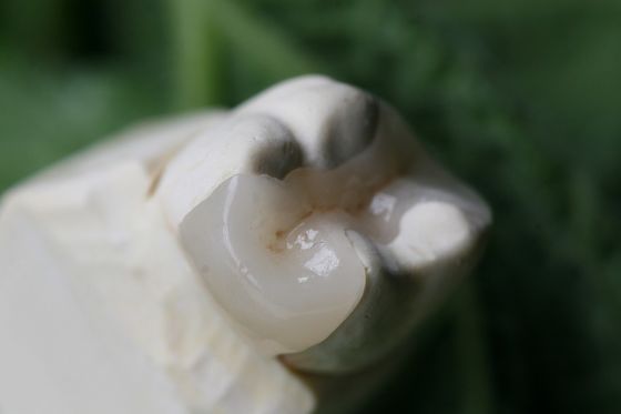 Onlay Ve Inlay Estetik Yapay EMAX Dental Crown
