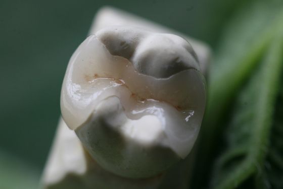 Sabit Protezler Kalıcı Çözüm EMAX Dental Crown