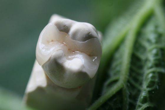 Doğal Görünümlü Tüm Porselen Kaplamalar EMAX Dental Crown