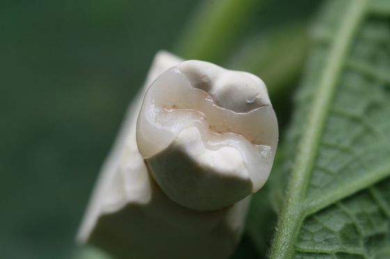 Sabit Protezler Kalıcı Çözüm EMAX Dental Crown
