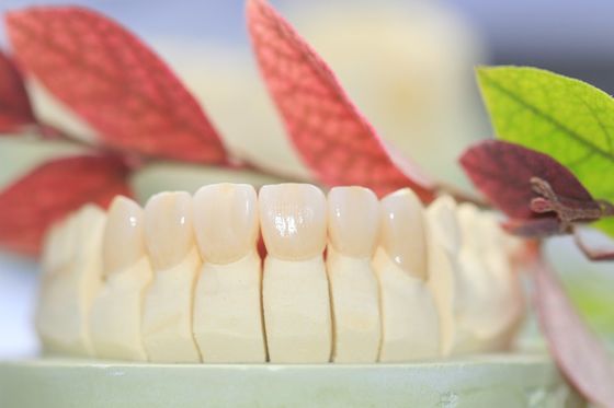 Ön Dişler İçin Diş Laboratuvarı Sabit Protez Katmanlı Zirkonya Diş Tacı