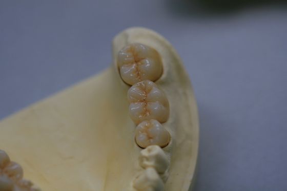 Diş Laboratuvarı Zirkonyum Oksit Porselen Zirkonya Seramikli Diş Tacı