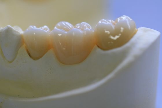 Ön Dişler İçin Diş Laboratuvarı Sabit Protez Katmanlı Zirkonya Diş Tacı