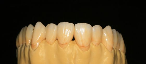 Ön Dişler İçin Diş Laboratuvarı Sabit Protez Katmanlı Zirkonya Diş Tacı
