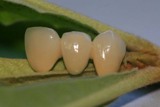 ISO13485 İyi Biyouyumluluk PFM Değerli Olmayan Dental Kron