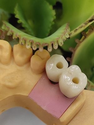 Çimentolu Çözüm NOBEL BIOCARE Dental Implants Crown