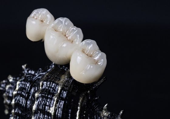 Metal Çerçeve PFM Dental Kron