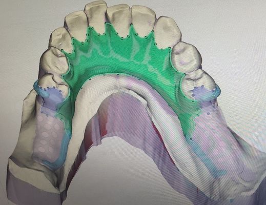 Çıkarılabilir 3D Baskılı Kısmi Protez Metal Çerçeve