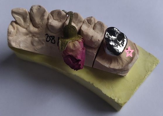 Tam Döküm Bazlı Metal Alaşımları Dental Kron