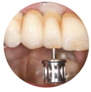Doğal ASC Açılı Vida Kanallı Dental İmplantlar Kron