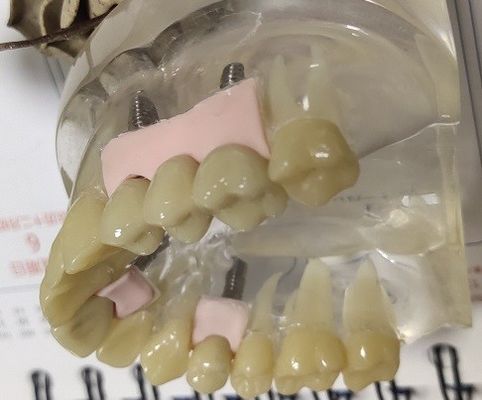 Yüzde 100 Biyouyumluluk PMMA Geçici Taç