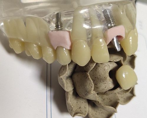 Metal Boş Frezeleme PFM İç Taç Dental 3D Baskı