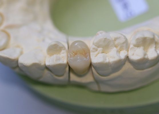 Azı Dişleri İçin Estetik Cam Seramik EMAX Posterior Kuronlar