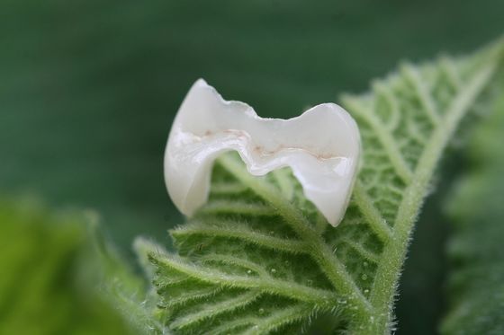 Onlay Ve Inlay Estetik Yapay EMAX Dental Crown