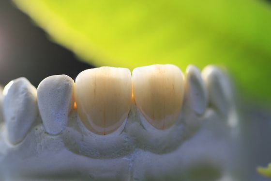 Diş Hekimliği için 3D Baskı Çerçevesi PFM Dental Lab Crown